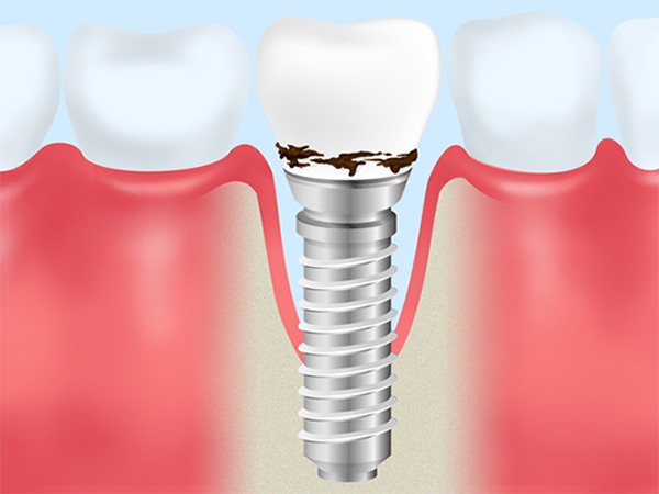 インプラント周囲炎の原因