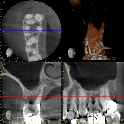 歯科用CTを活用した正確な診査診断