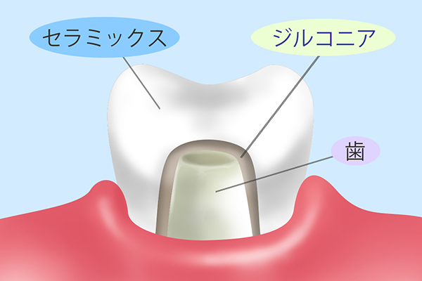 ジルコニア