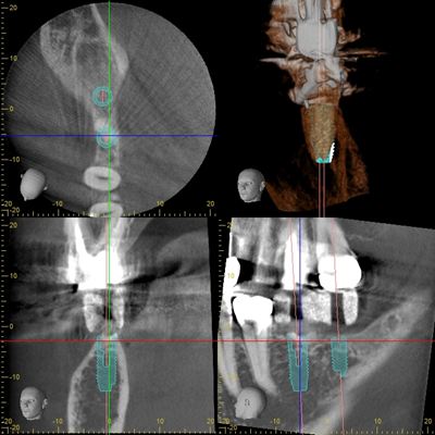歯科用CTを活用した精密診断