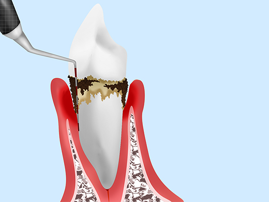 歯周病の治療