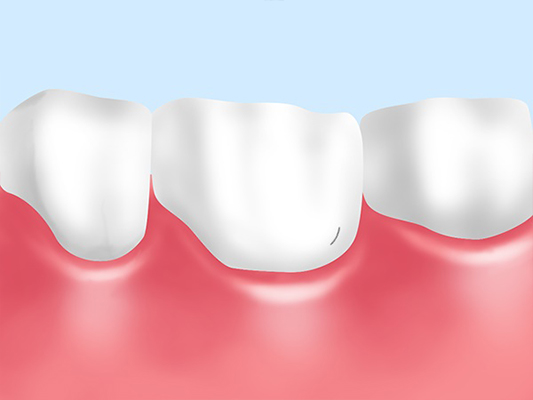 歯の亀裂の確認