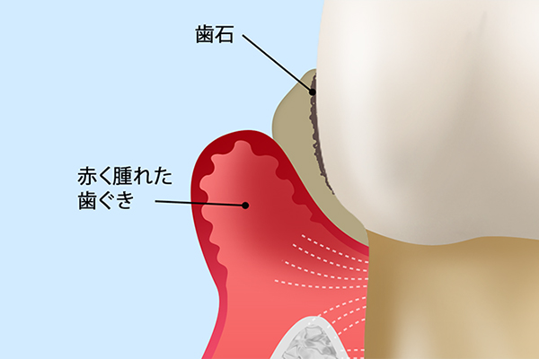 歯周病専門医による歯周病治療