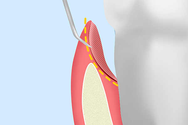 歯周ポケットそうは術