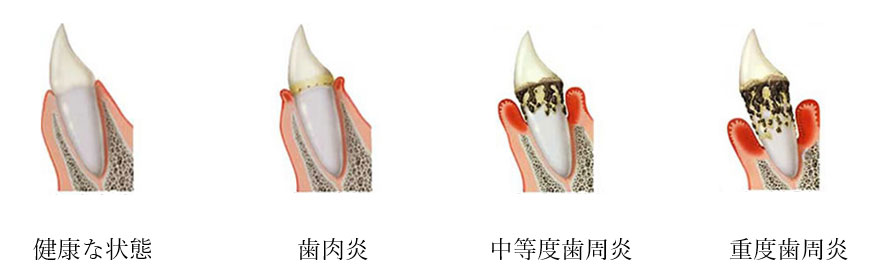 なぜ歯周病の治療が大切なのか？