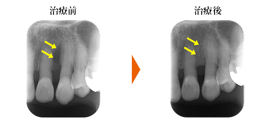 歯周病により失った骨を回復する治療