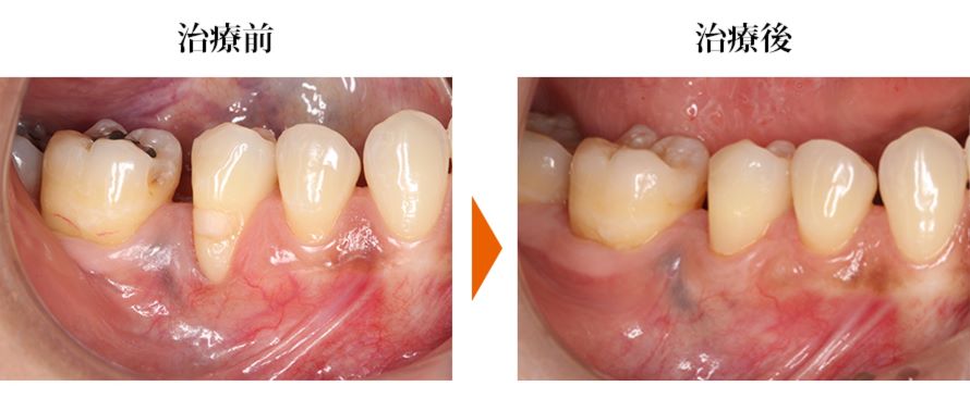 根面被覆術で改善した症例