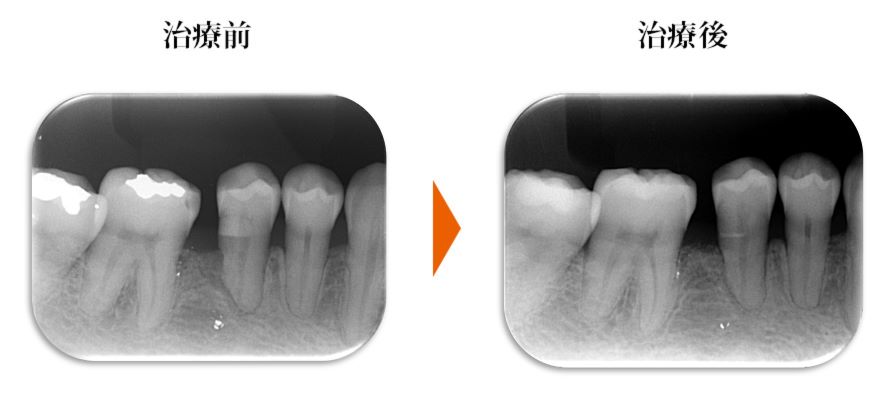 根面被覆術で改善した症例