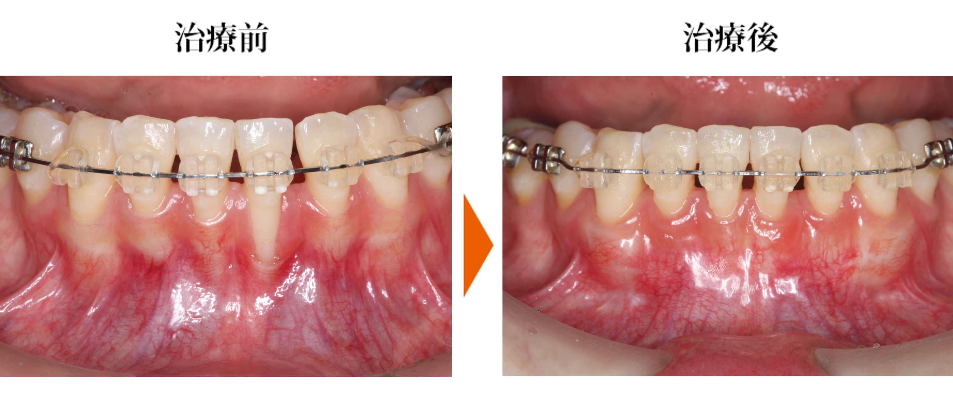 歯肉退縮の改善と歯根が透過している部分の歯肉の厚みの改善