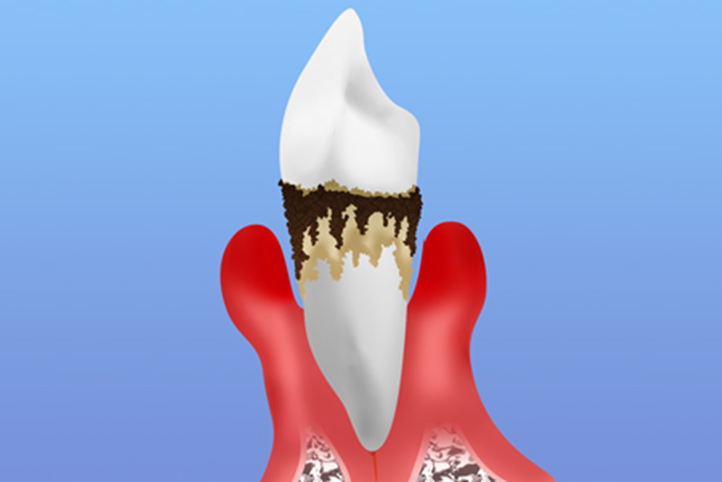 重度の歯周病治療について