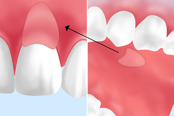 結合組織移植（CTG：Connective Tissue Graft）