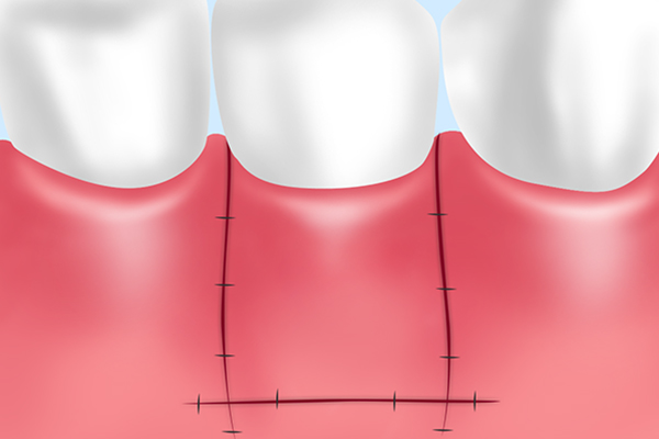 遊離歯肉移植（FGG：Fee Gingival Graft）