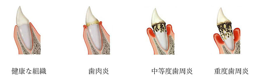 重度歯周病とは