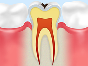 C1：エナメル質のむし歯