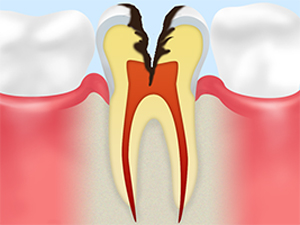 C3：神経のむし歯