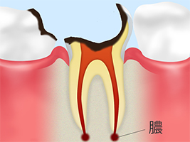 C4：歯根のむし歯